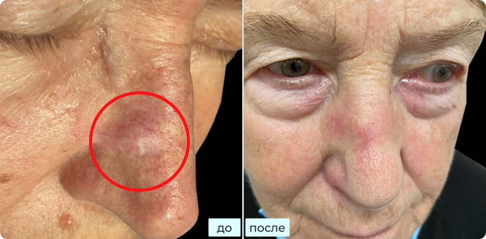 Удаление плоскоклеточного рака кожи методом хирургии Моса (MOHS)