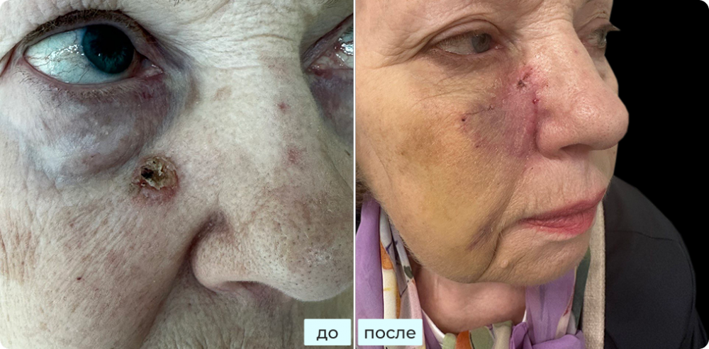 Удаление базалиомы под глазом, удаление базалиомы нижнего века методом хирургии Моса (MOHS) с реконструкцией в Москве