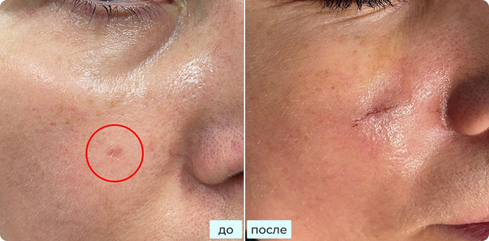 Удаление плоскоклеточного рака in situ (болезнь Боуэна)методом хирургии Моса (MOHS)