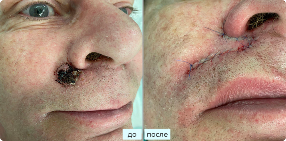 Удаление базалиомы с распадом (некрозом)